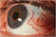 Assessment of area and structural irregularity of retinal layers in diabetic retinopathy using machine learning and image processing techniques