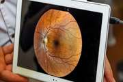 Artificial Intelligence to Detect Papilledema from Ocular Fundus Photographs