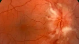 Acute Demyelinating Optic Neuritis