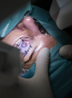  Intermediate Oculoplastic Surgery