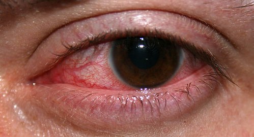 Deep learning based classification of fungal and Acanthamoeba keratitis using confocal microscopy