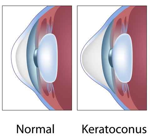The microenvironment of ocular surface in keratoconus: a systematic review